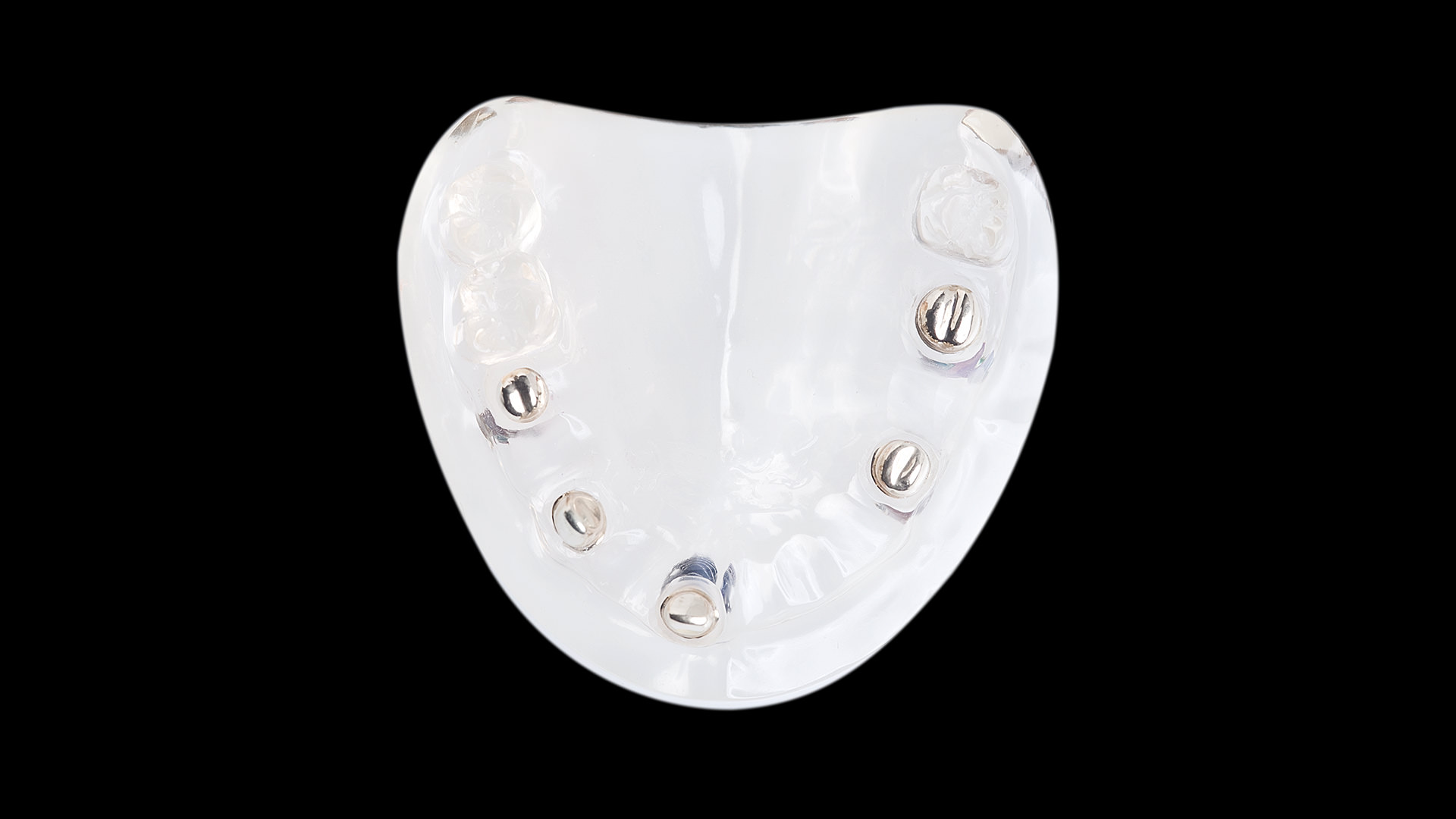 festsitzende-implantatversorgung-1