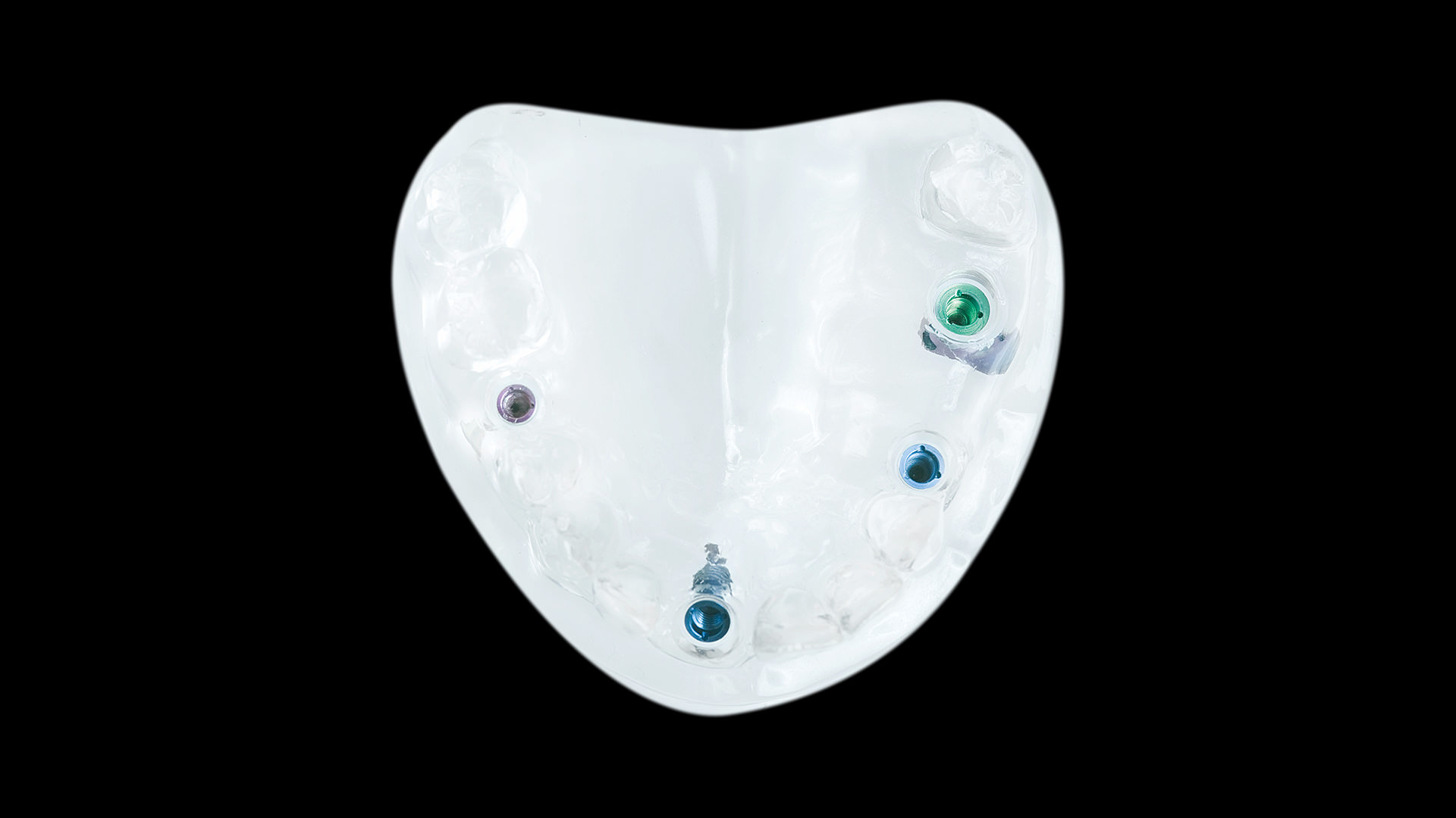 implantatbruecke-1